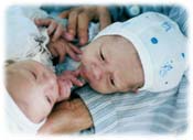 siamese twins pictures