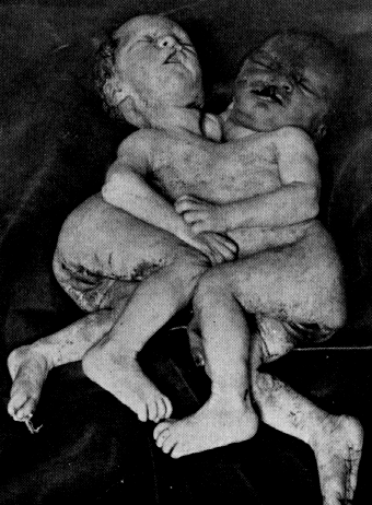 Should Siamese twins always be separated? 